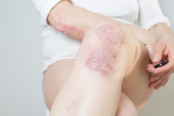 Psoriasis: Causes, Symptoms, and Treatment